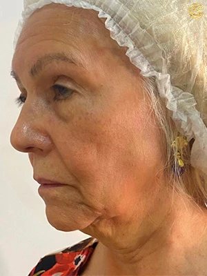 Foto antes e depois