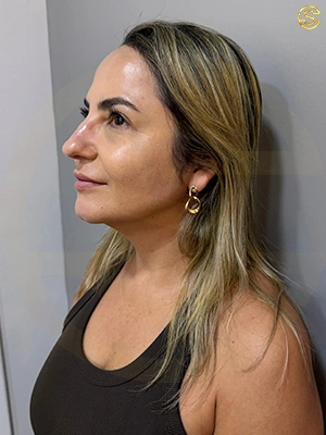 Foto antes e depois