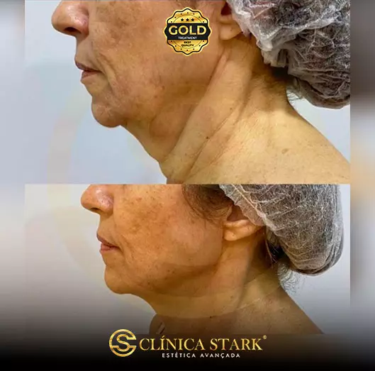 Foto antes e depois do ultraformer na redução de papada de uma mulher