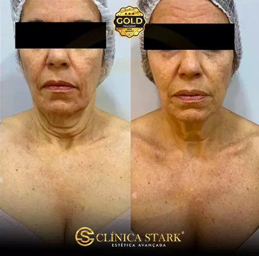 Foto antes e depois do ultraformer na redução de papada de uma mulher