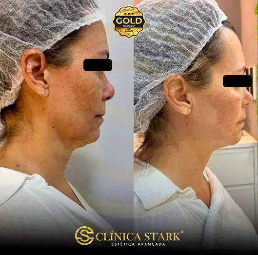 Foto antes e depois de lifting facial de uma mulher