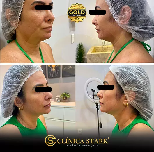 Foto antes e depois de lifting facial de uma mulher