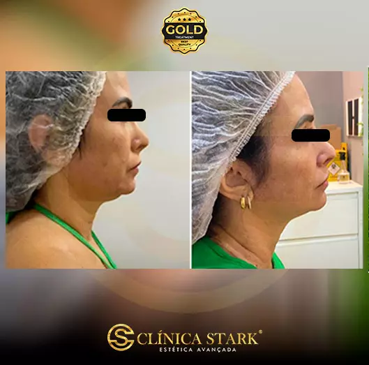 Foto antes e depois de lifting facial de uma mulher