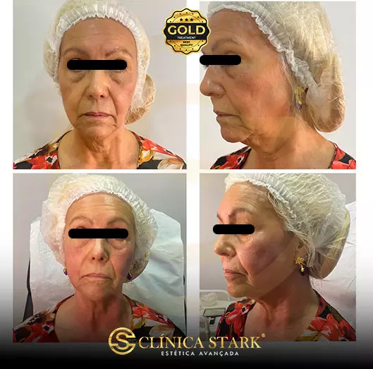 Foto antes e depois de lifting facial de uma mulher