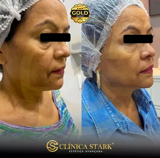 Foto antes e depois de lifting facial de uma mulher