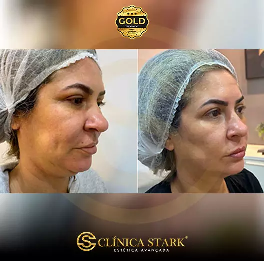 Foto antes e depois de lifting facial de uma mulher
