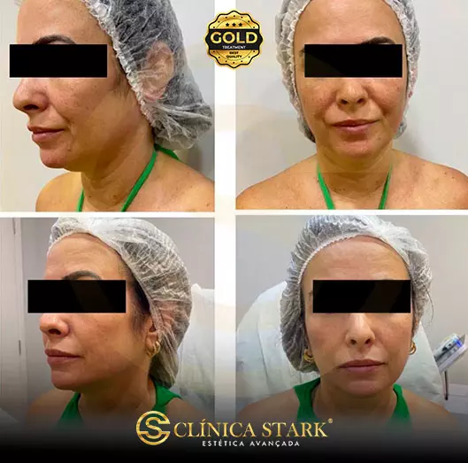 Foto antes e depois de lifting facial de uma mulher