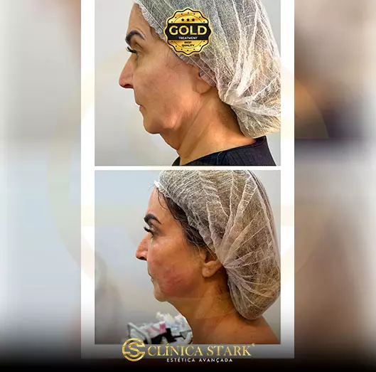 Foto antes e depois de lifting facial de uma mulher