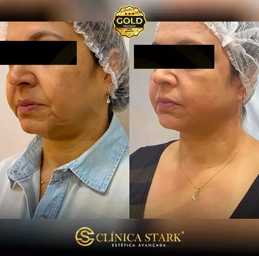Foto antes e depois de lifting facial de uma mulher