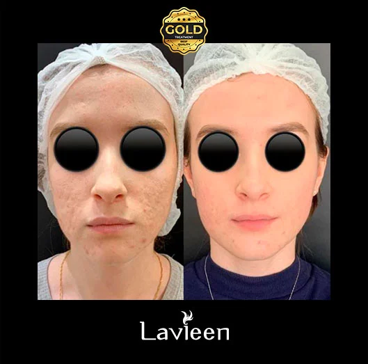 Laser Lavieen O laser que deixa a pele como porcelana Efeito BB Cream