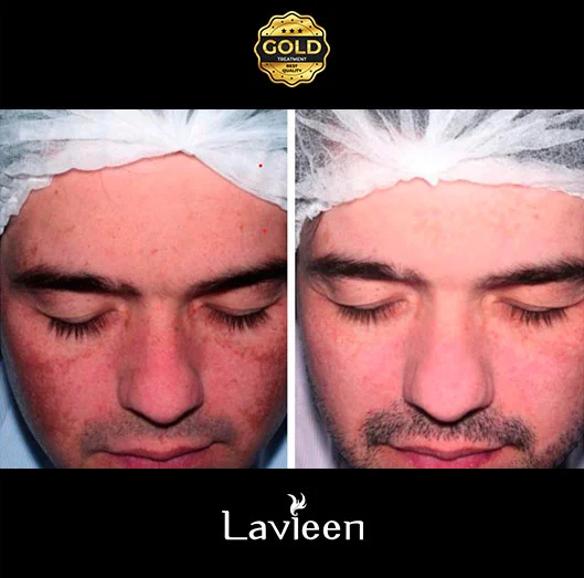Antes e depois do tratamento estético com laser lavieen, laser de Thulium