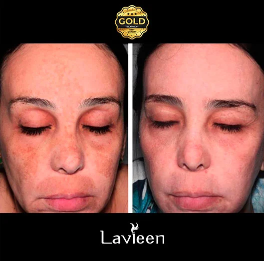 Laser Lavieen O laser que deixa a pele como porcelana Efeito BB Cream